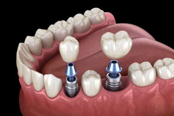 Dental Implants Dental Implants