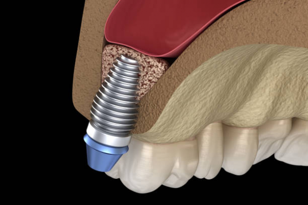 Implant with Sinus Lift