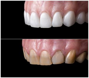 Dental Veneers