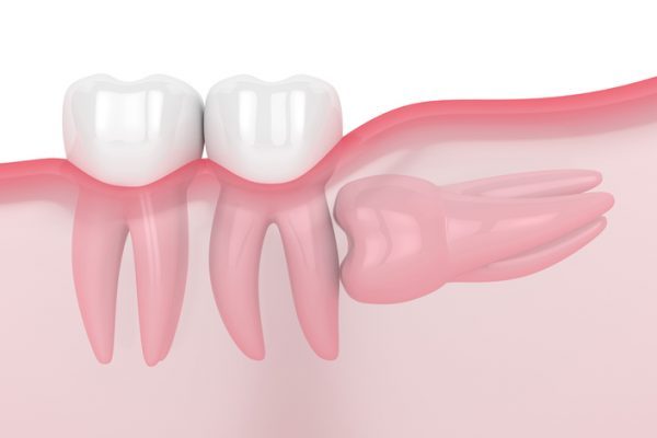 Impacted tooth