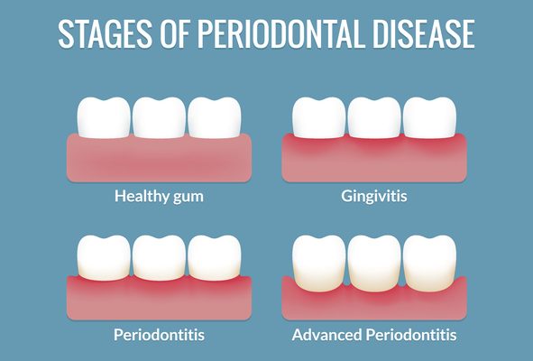Periodontal Disease