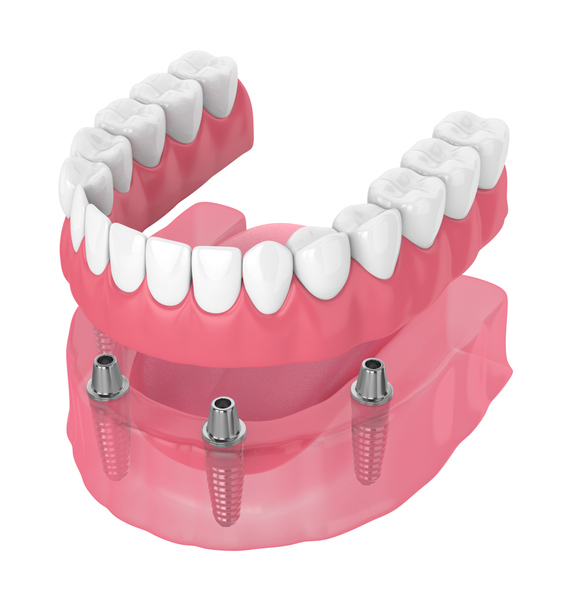 All-on-4 Dental Implants