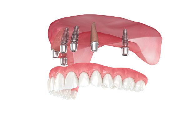 All-on-6 Dental Implants
