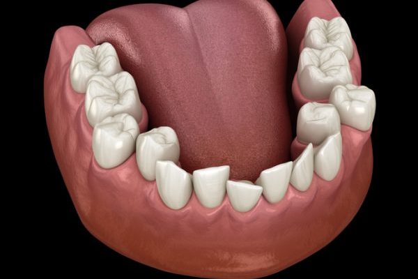Overcrowded teeth