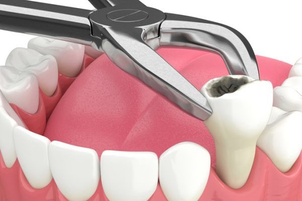 Tooth Decay
